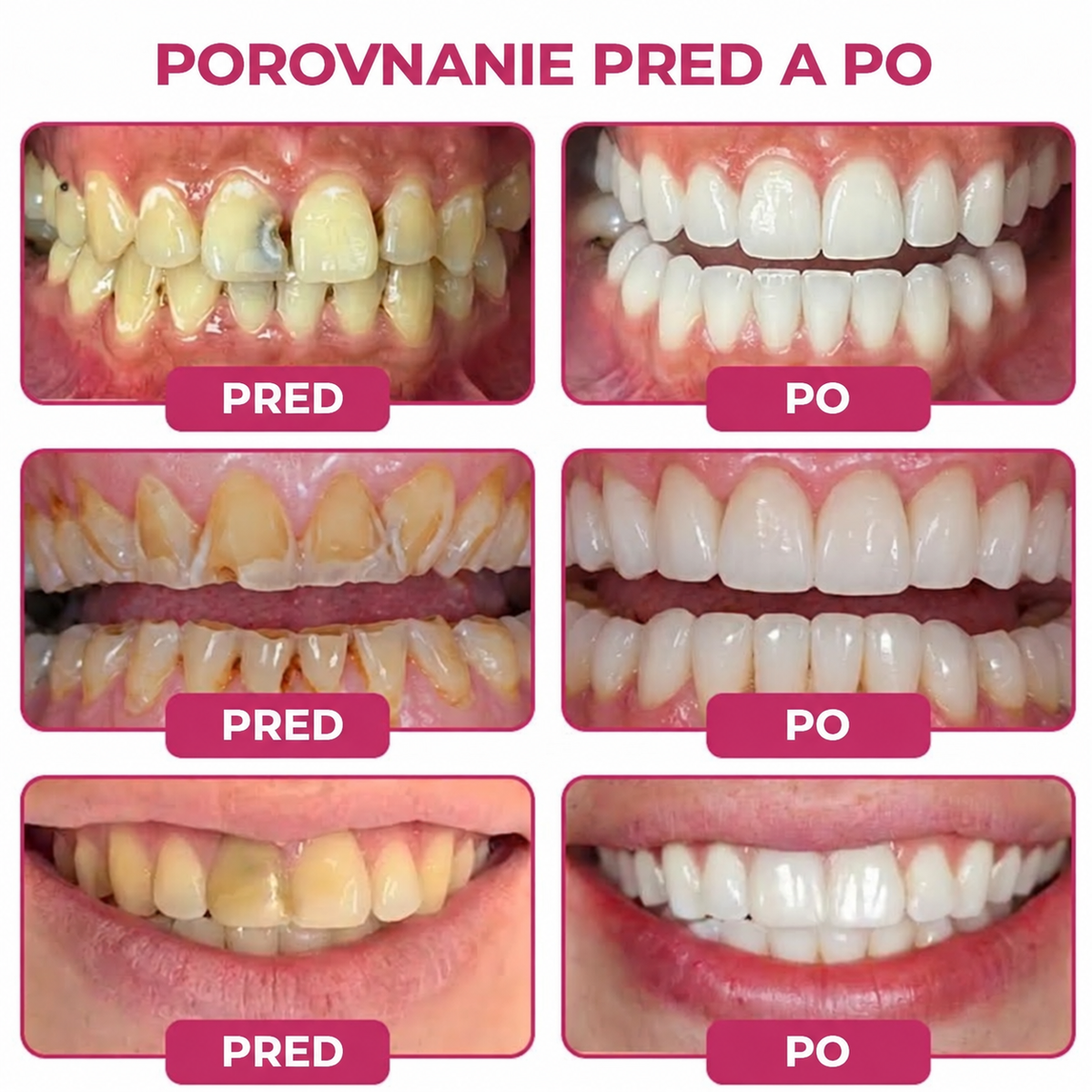 🇸🇰🚩🚩Rolimey® DenPerm – Prírodný gél na doplnenie zubnej skloviny na obnovu zubov poškodených kazom