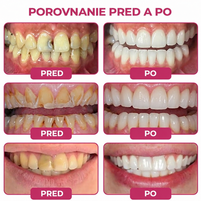 🇸🇰🚩🚩Rolimey® DenPerm – Prírodný gél na doplnenie zubnej skloviny na obnovu zubov poškodených kazom