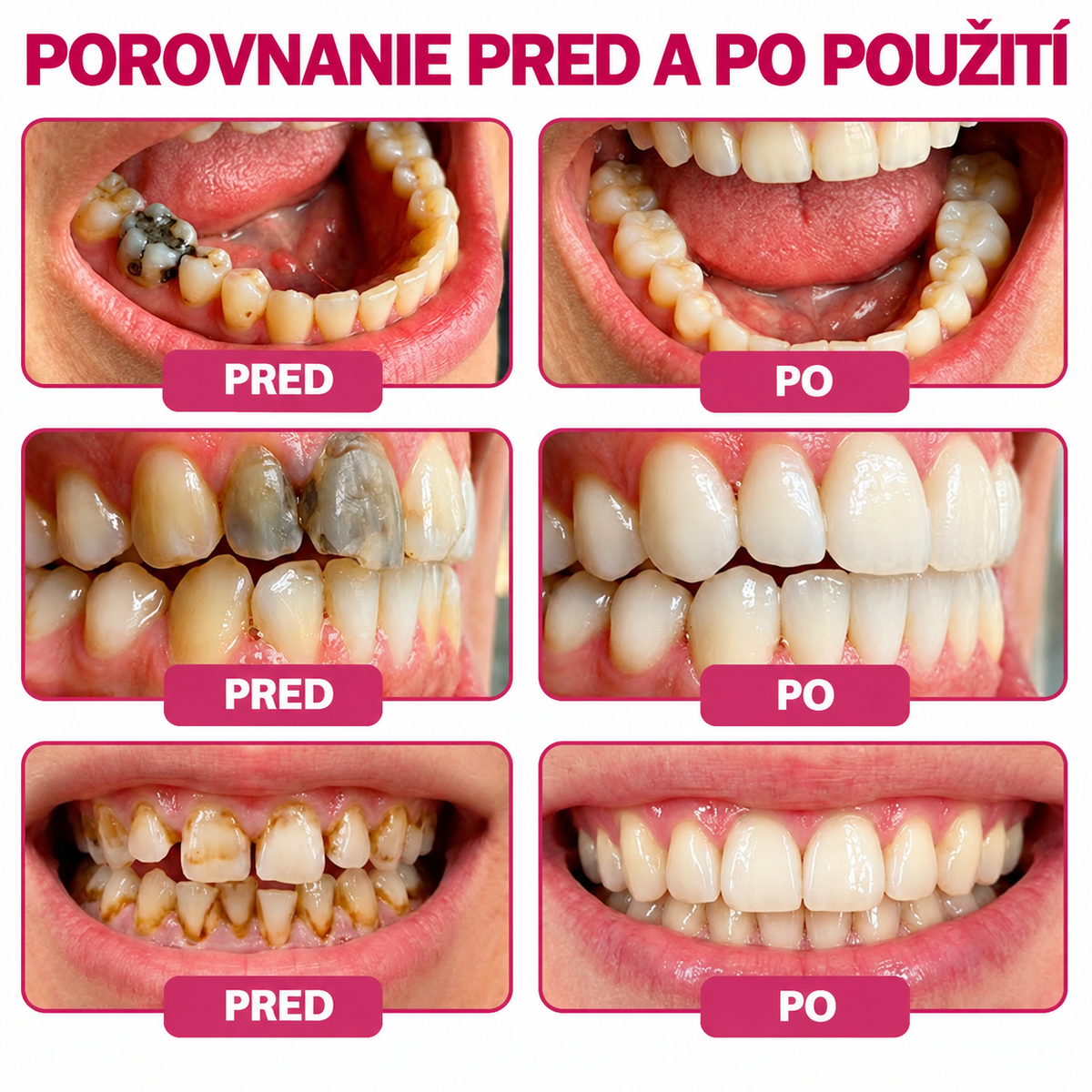 🇸🇰🚩🚩Rolimey® DenPerm – Prírodný gél na doplnenie zubnej skloviny na obnovu zubov poškodených kazom