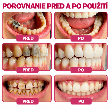 🇸🇰🚩🚩Rolimey® DenPerm – Prírodný gél na doplnenie zubnej skloviny na obnovu zubov poškodených kazom