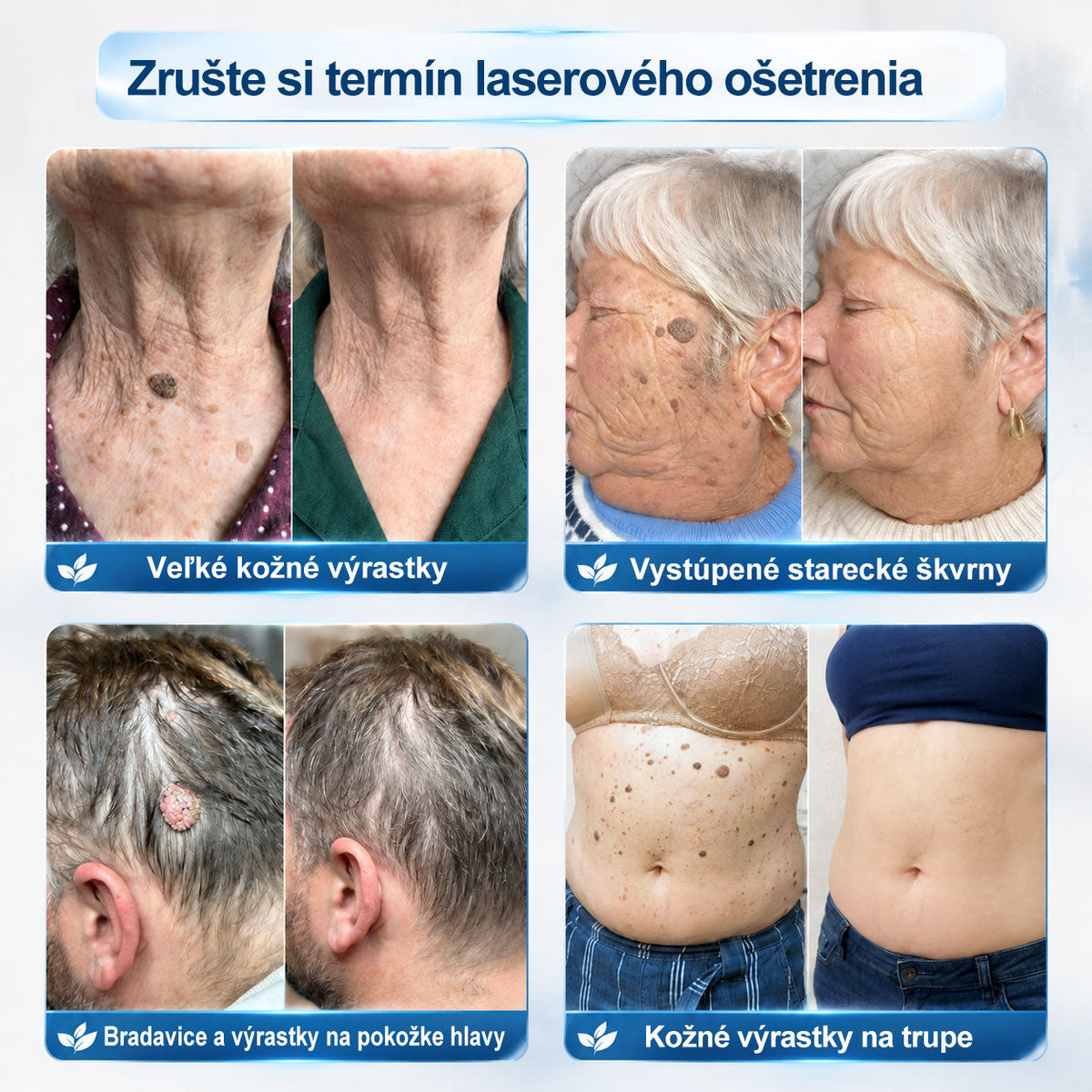 𝐎𝐟𝐢𝐜𝐢𝐚𝐥𝐧𝐲 𝐨𝐛𝐜𝐡𝐨𝐝 𝐦𝐚𝐫𝐤𝐲 |✅️🧶𝐏i𝐜𝐝o® 7dni Prípravok na odstránenie kožných výrastkov a pigmentových škvŕn (bezbolestný roll-on aplikátor bez jaziev)