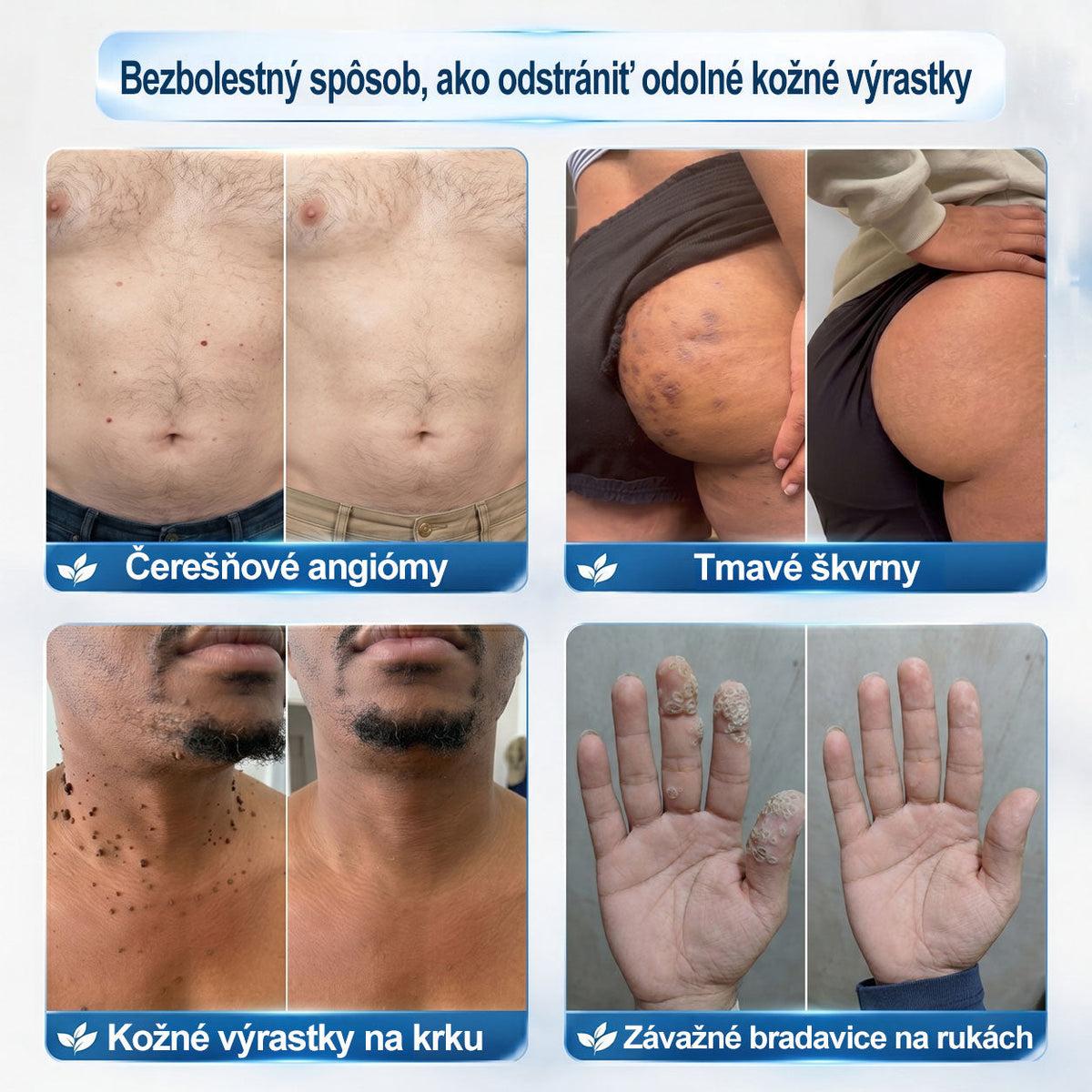 𝐎𝐟𝐢𝐜𝐢𝐚𝐥𝐧𝐲 𝐨𝐛𝐜𝐡𝐨𝐝 𝐦𝐚𝐫𝐤𝐲 |✅️🧶𝐏i𝐜𝐝o® 7dni Prípravok na odstránenie kožných výrastkov a pigmentových škvŕn (bezbolestný roll-on aplikátor bez jaziev)