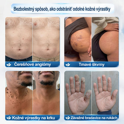 𝐎𝐟𝐢𝐜𝐢𝐚𝐥𝐧𝐲 𝐨𝐛𝐜𝐡𝐨𝐝 𝐦𝐚𝐫𝐤𝐲 |✅️🧶𝐏i𝐜𝐝o® 7dni Prípravok na odstránenie kožných výrastkov a pigmentových škvŕn (bezbolestný roll-on aplikátor bez jaziev)