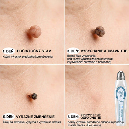 𝐎𝐟𝐢𝐜𝐢𝐚𝐥𝐧𝐲 𝐨𝐛𝐜𝐡𝐨𝐝 𝐦𝐚𝐫𝐤𝐲 |✅️🧶𝐏i𝐜𝐝o® 7dni Prípravok na odstránenie kožných výrastkov a pigmentových škvŕn (bezbolestný roll-on aplikátor bez jaziev)